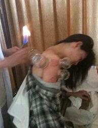 明星 拔罐,拔罐疗法揭秘